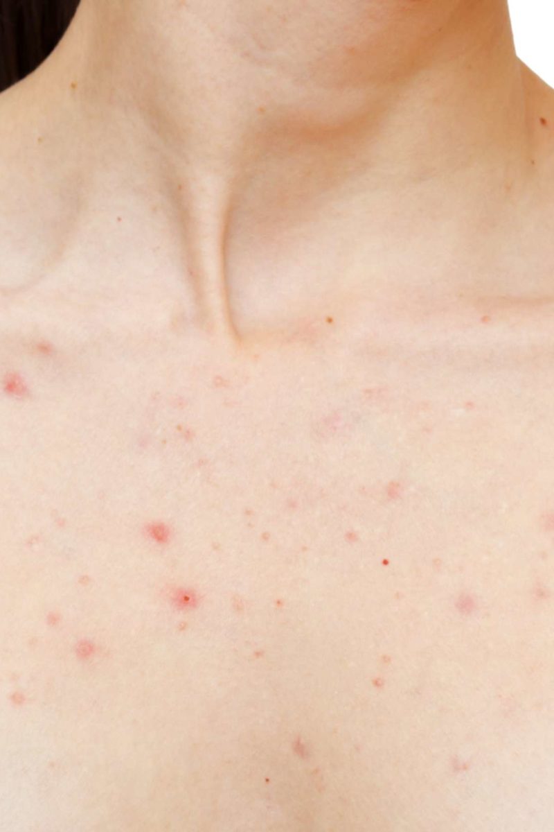 acne-bumps-on-chest