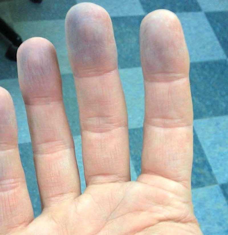 wrinkled-fingertips-causes-treatment-pain-redness-lupus-thyroid