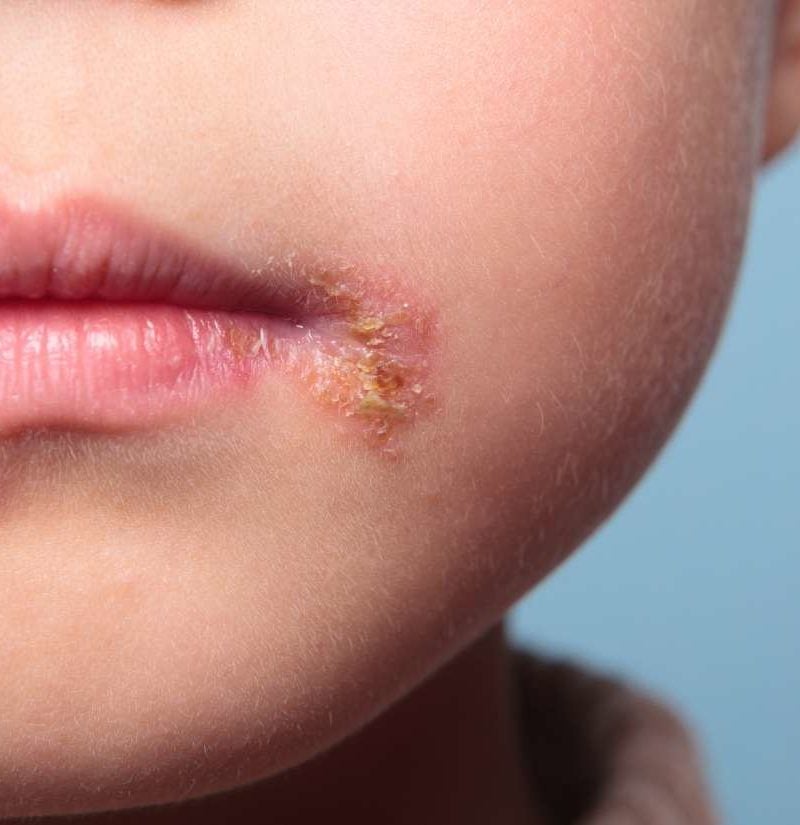 What Does A Cold Sore Look Like On Baby