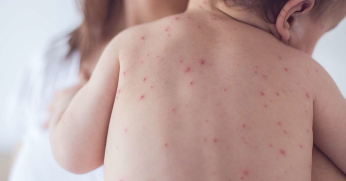 chicken pox rash pictures early stages