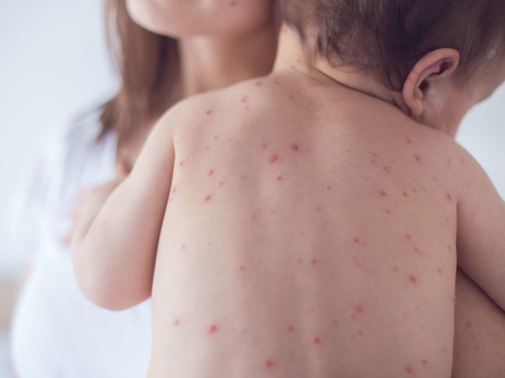 Nine succumb to Measles in Gujarat, second highest among all states