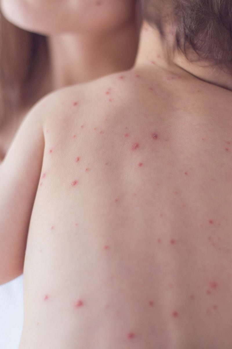 Chickenpox vs. measles: Symptoms, pictures, treatment, and more