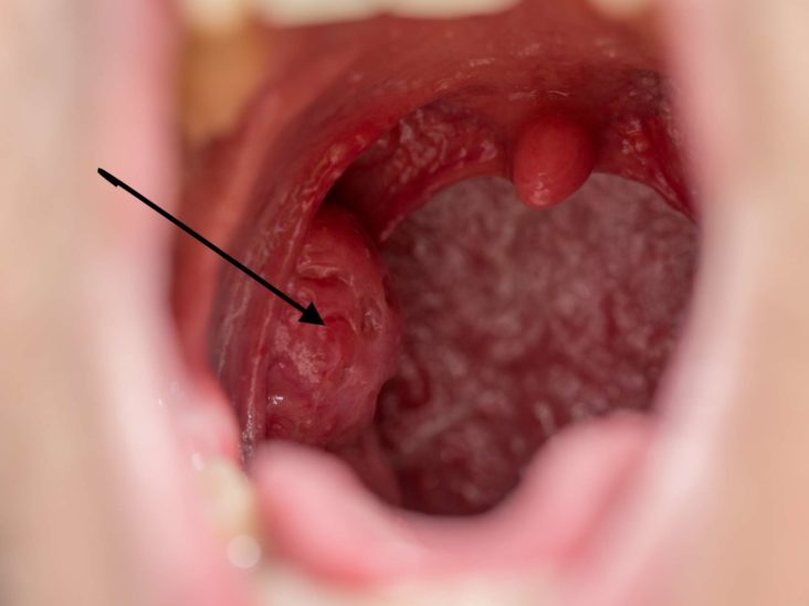 6 Home Remedies For Tonsil Stones