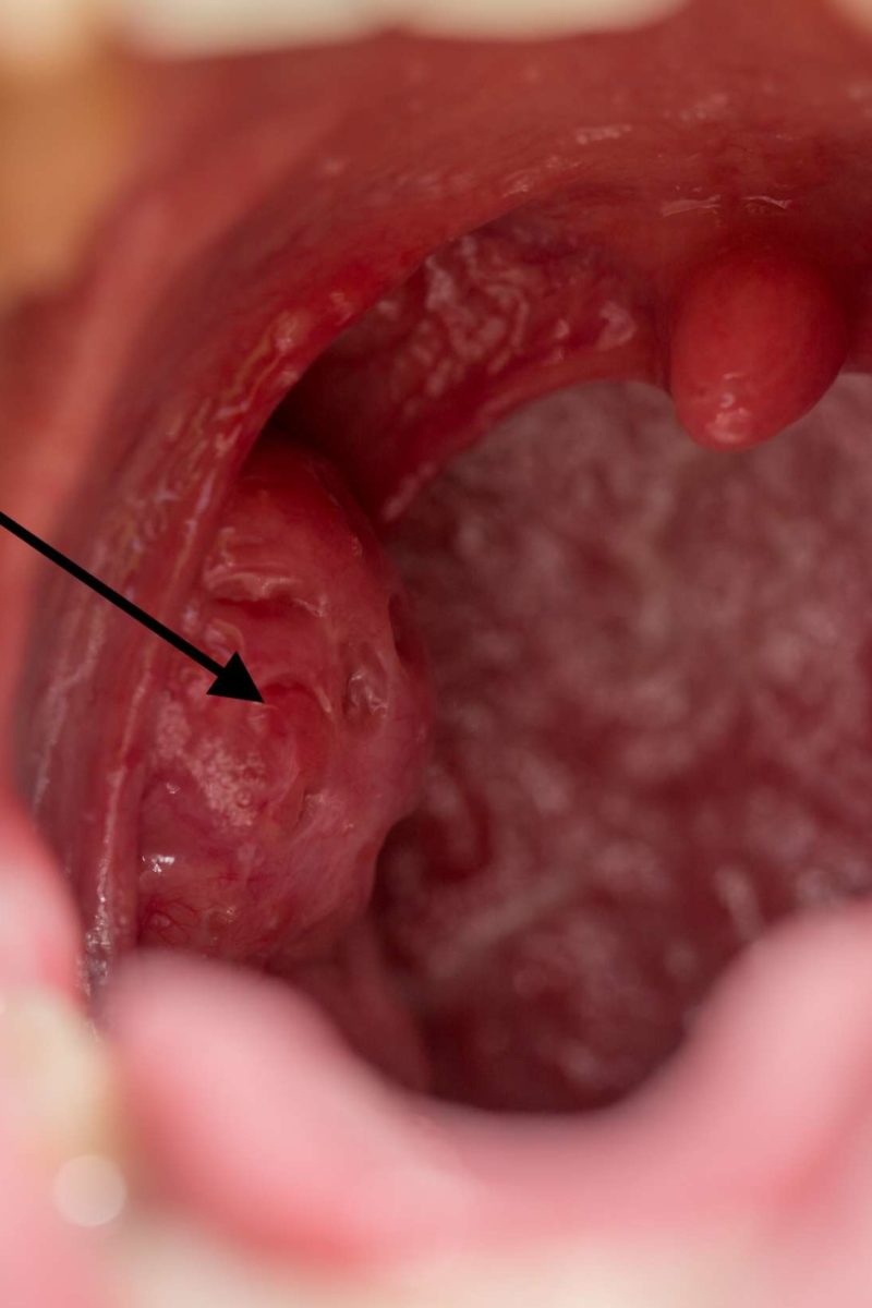 Holes in tonsils: Causes, symptoms, and treatment