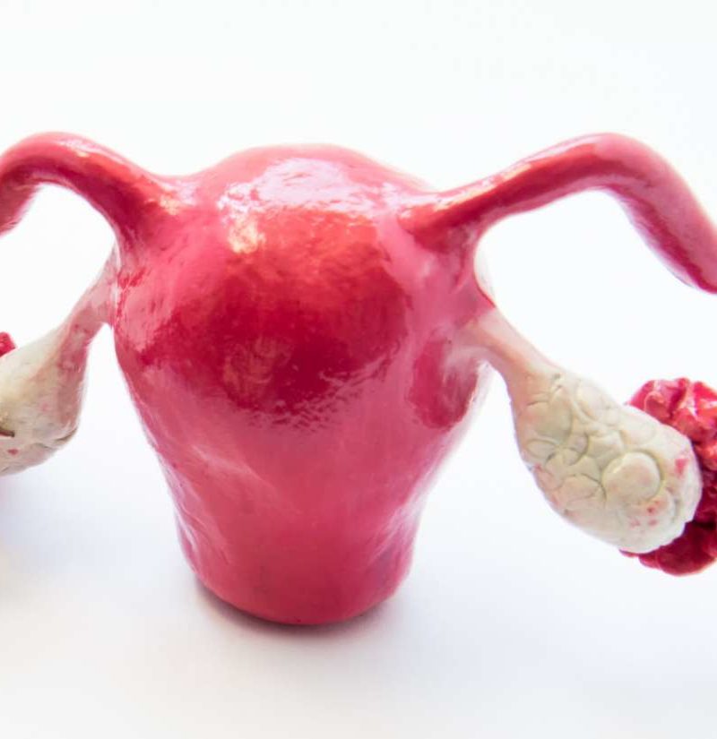 ovarian torsion symptoms image