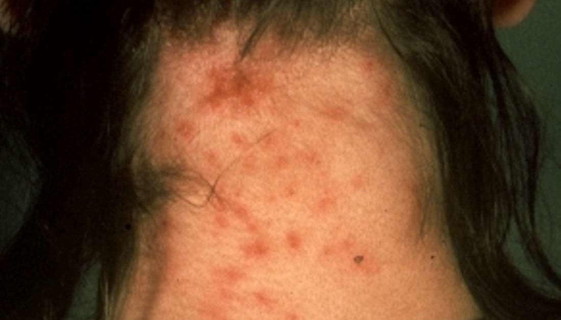 body lice rash