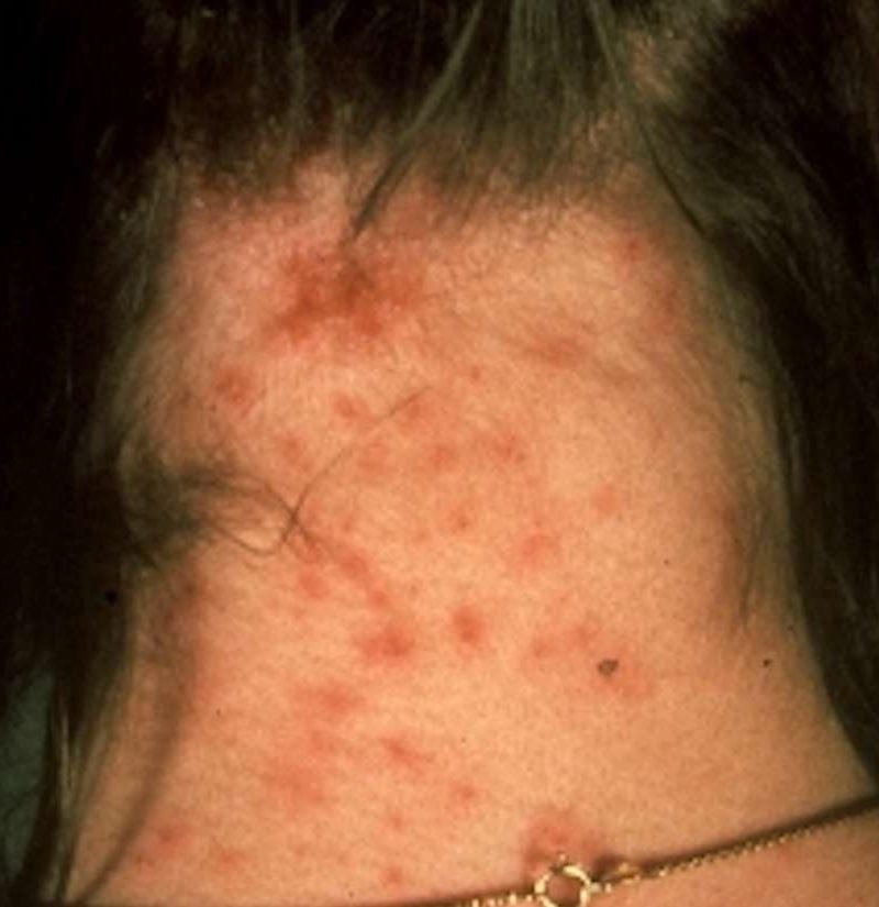 Lice Bites Pictures Identification And Treatment 