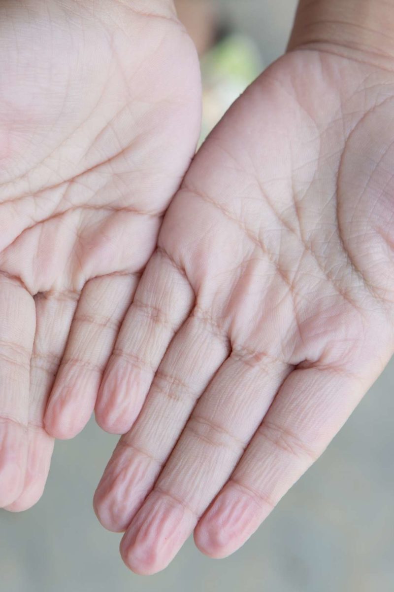 White Fingertips And Toes