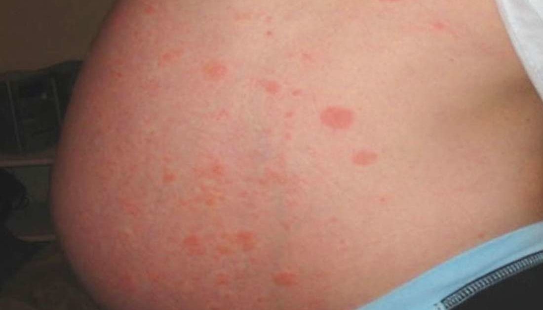 Small Rash On Body During Pregnancy