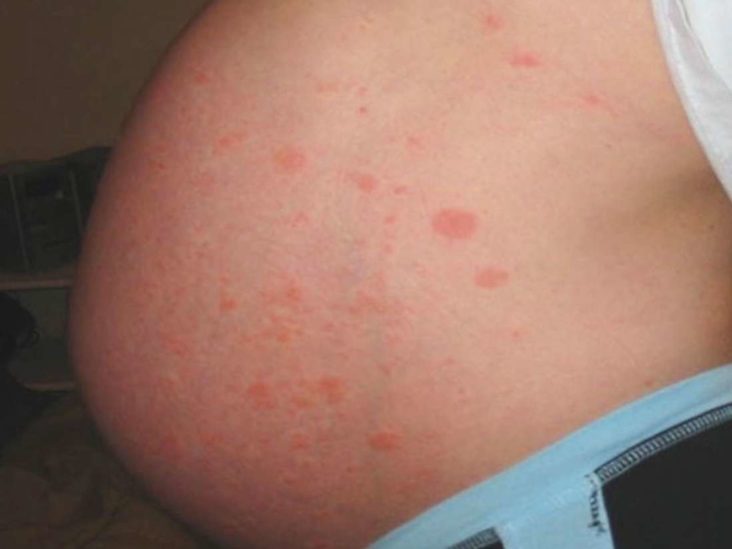 PUPPP rash in pregnancy: Natural treatments and prevention