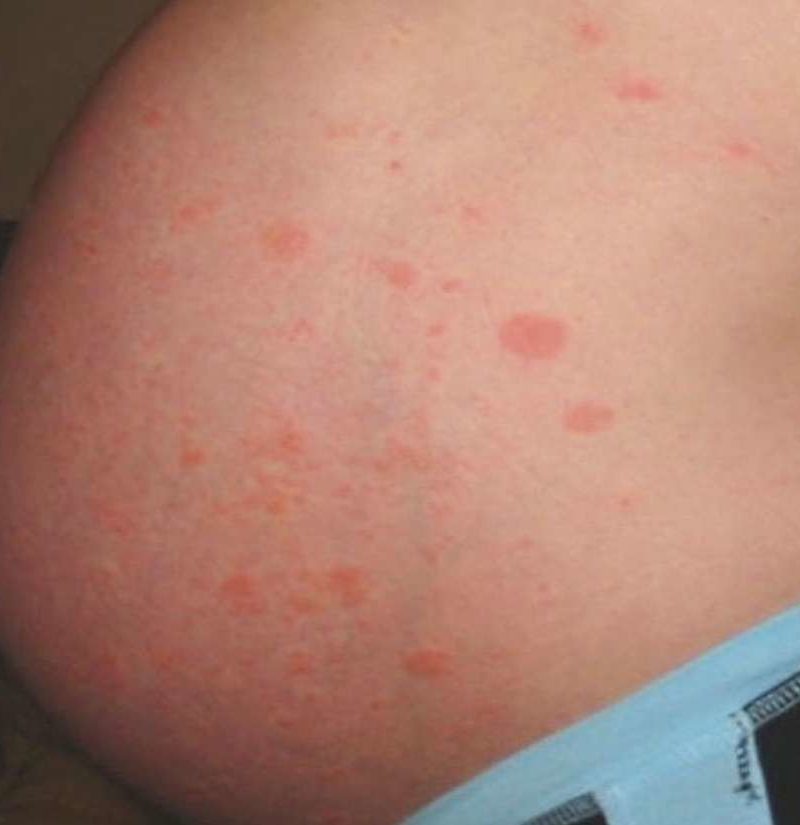 Pruritic Urticarial Papules and Plaques of Pregnancy - American