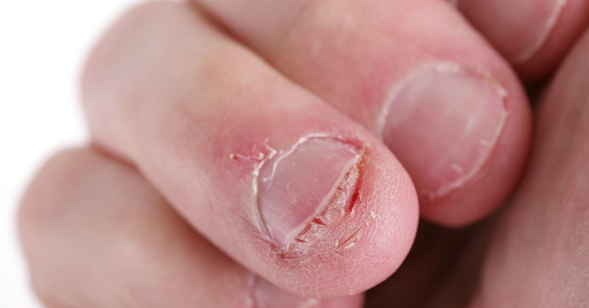 finger nail damage