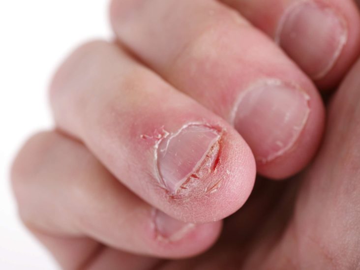 Paronychia Causes And Treatment Of An Infected Nail