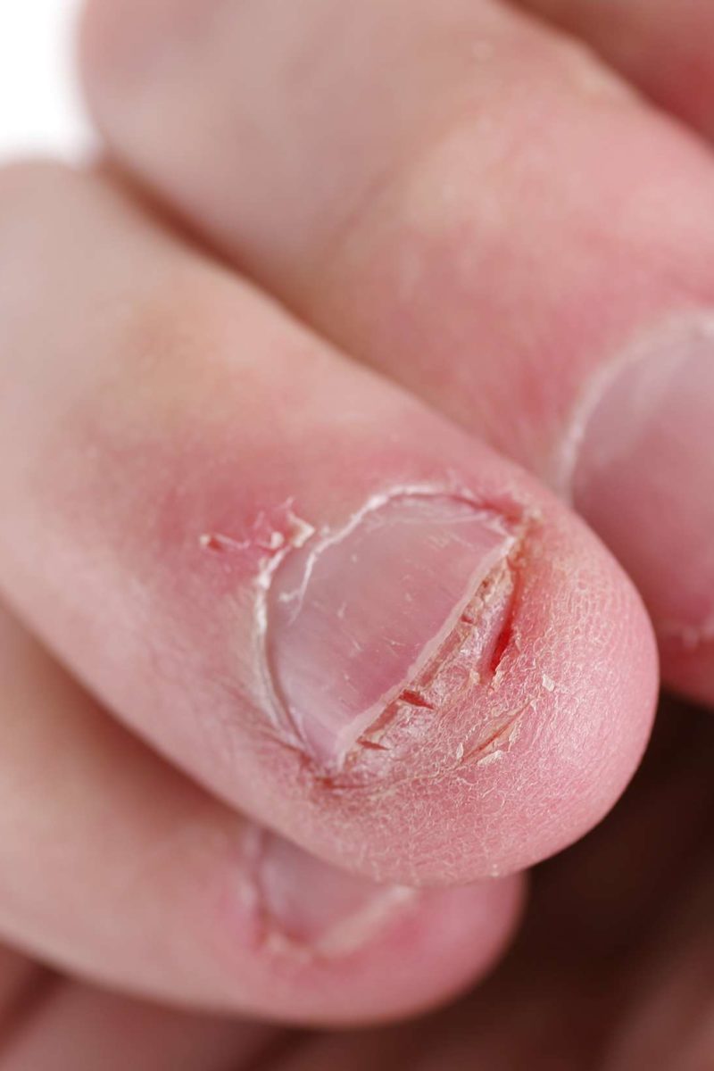 Viral Video Shows Fingernails Stuck in Child's Gums After Biting Nails |  Allure