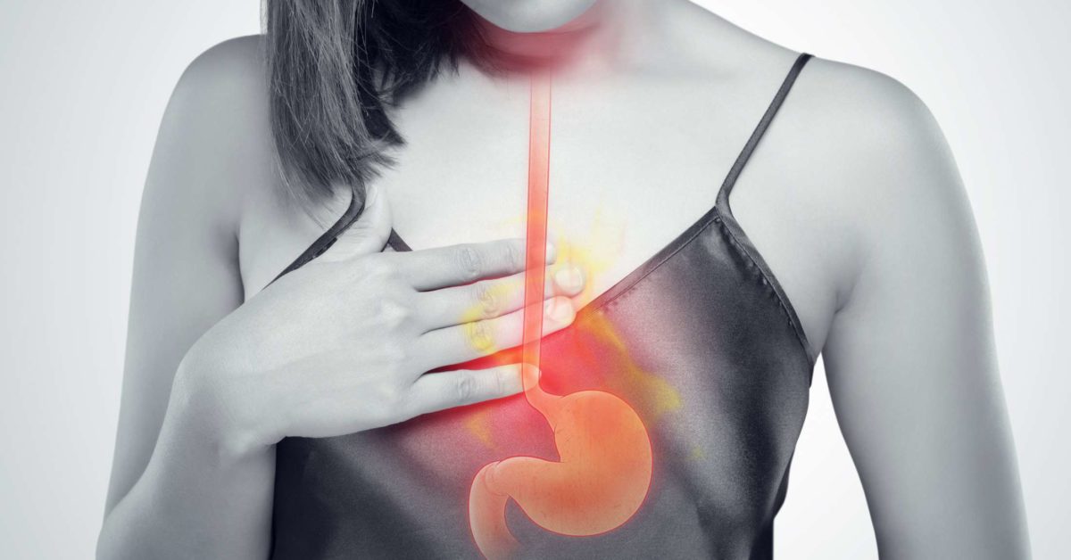 Heartburn, acid reflux, and GERD: What&#39;s the difference?