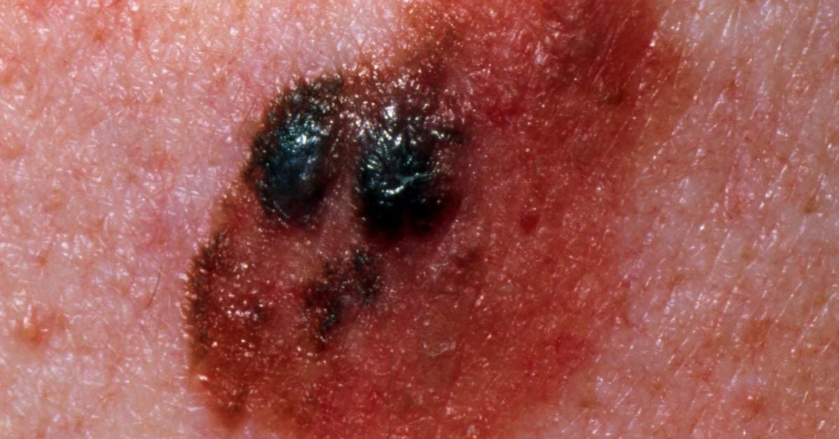 Stage Melanoma Survival Rate Pictures And Treatment