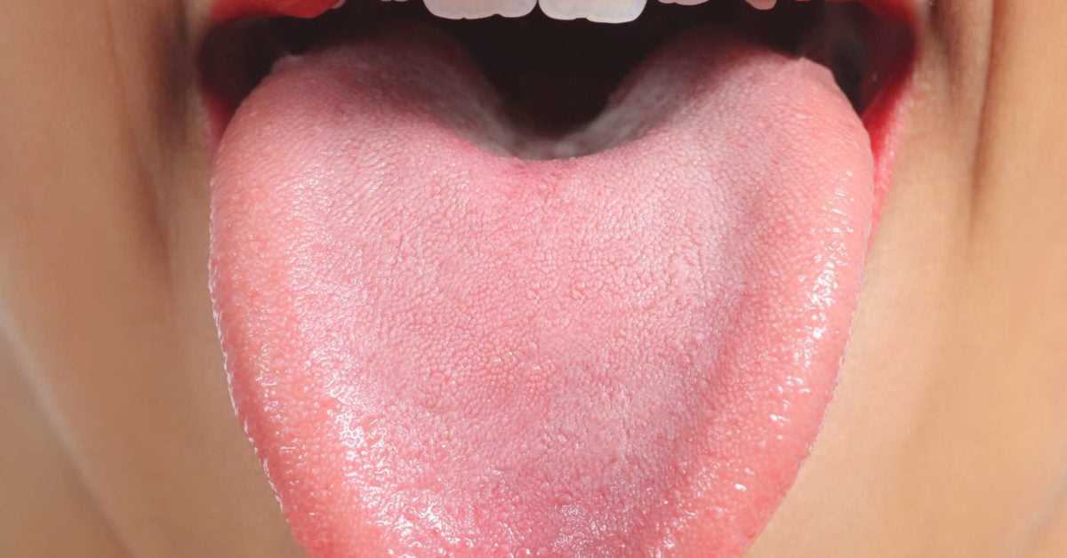 Tongue tip white of on bubble Pimples on