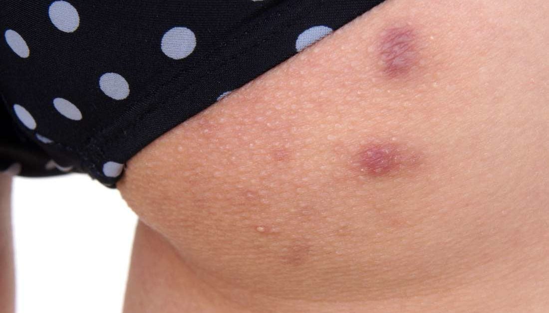 Butt acne: Home and natural treatments for folliculitis