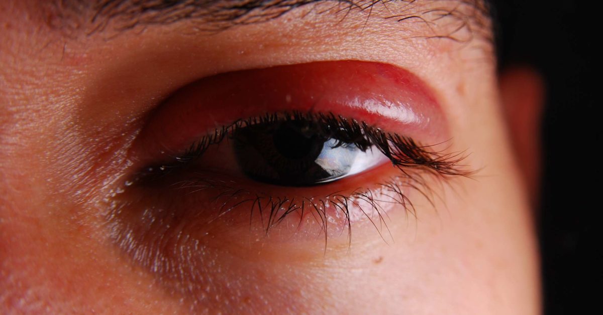 shingles-in-the-eye-symptoms-treatment-and-prevention