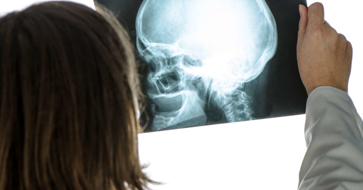 Skull fracture: Types, symptoms, and long-term effects