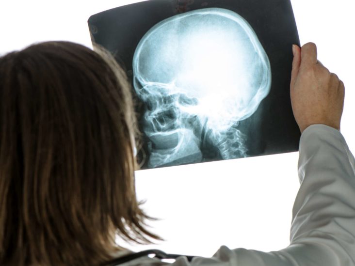 Skull fracture: Types, symptoms, and long-term effects