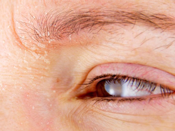 Eyebrow hair loss: Causes and treatments