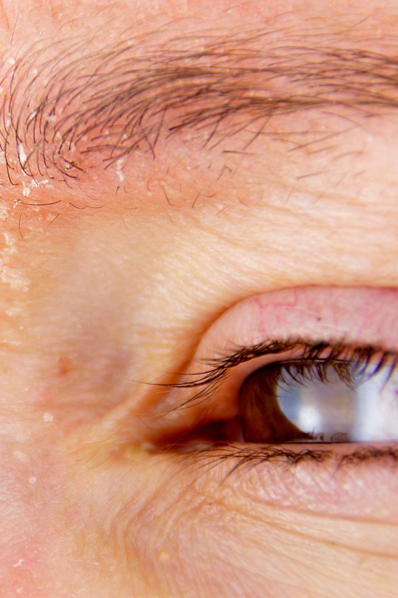 eczema on eyebrows