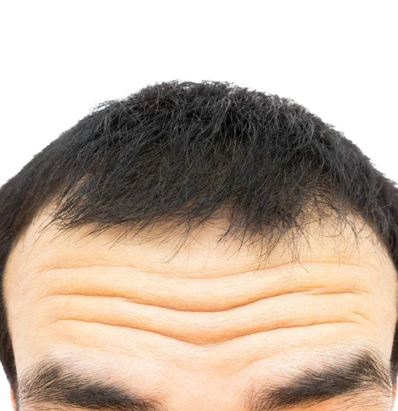 first wrinkle on forehead cea mai puternică cremă antirid cu retinol