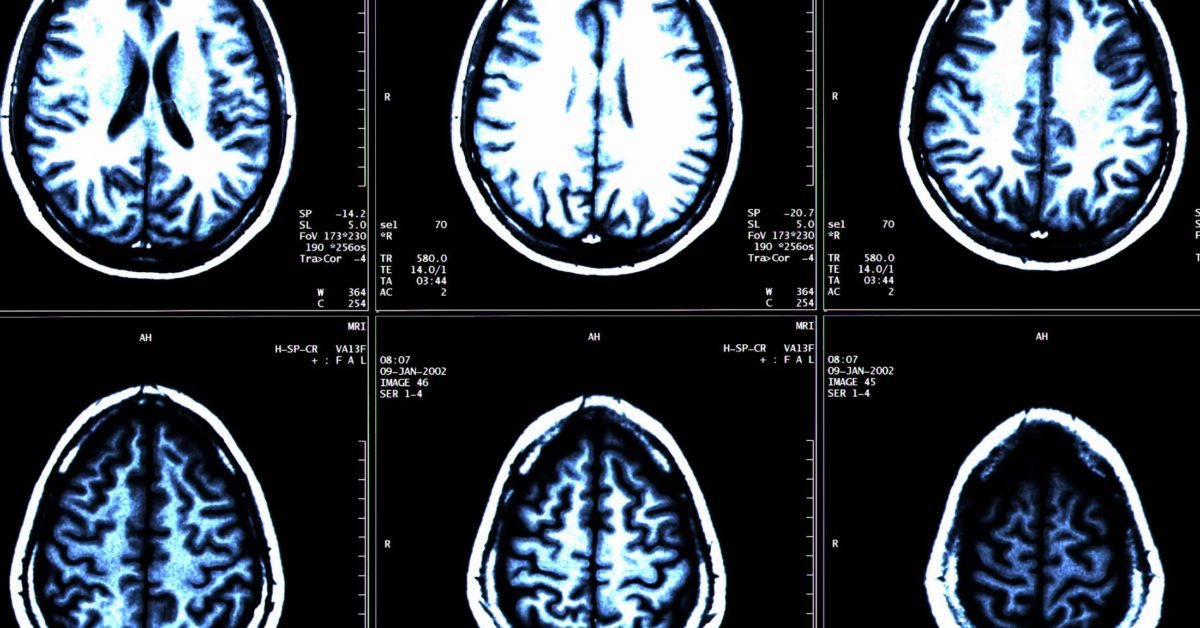 MS New Drug Proven To Slow Brain Shrinkage