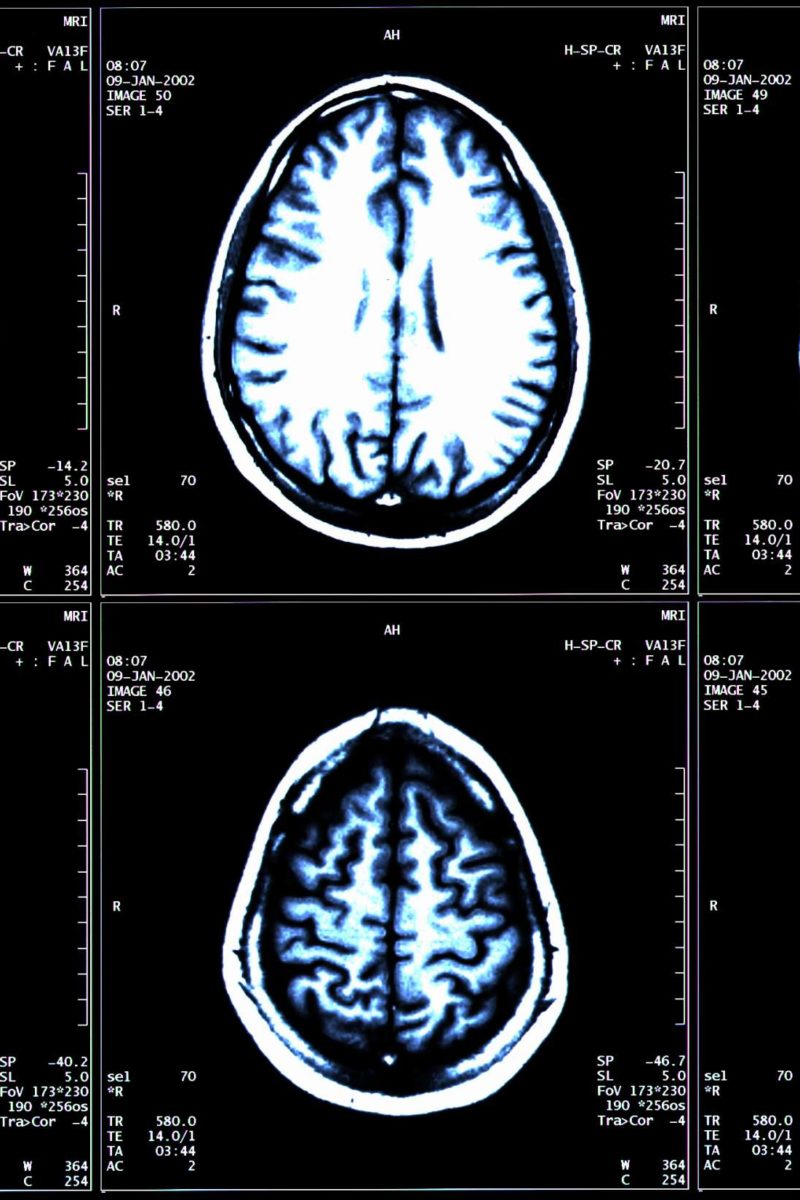 ms-new-drug-proven-to-slow-brain-shrinkage