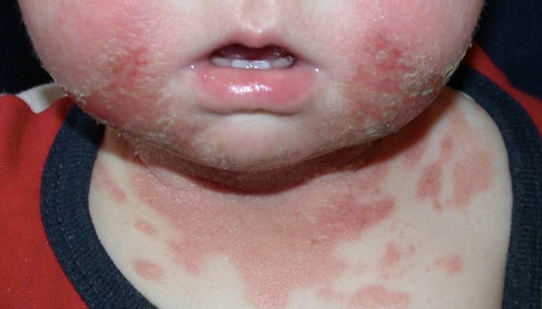 Drool Rash Treatment Prevention And When To See A Doctor