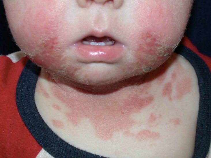 baby acne not eczema