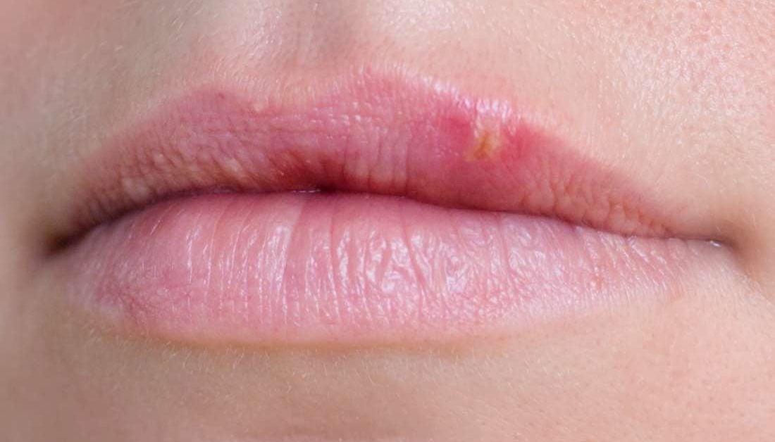 bump on upper lip