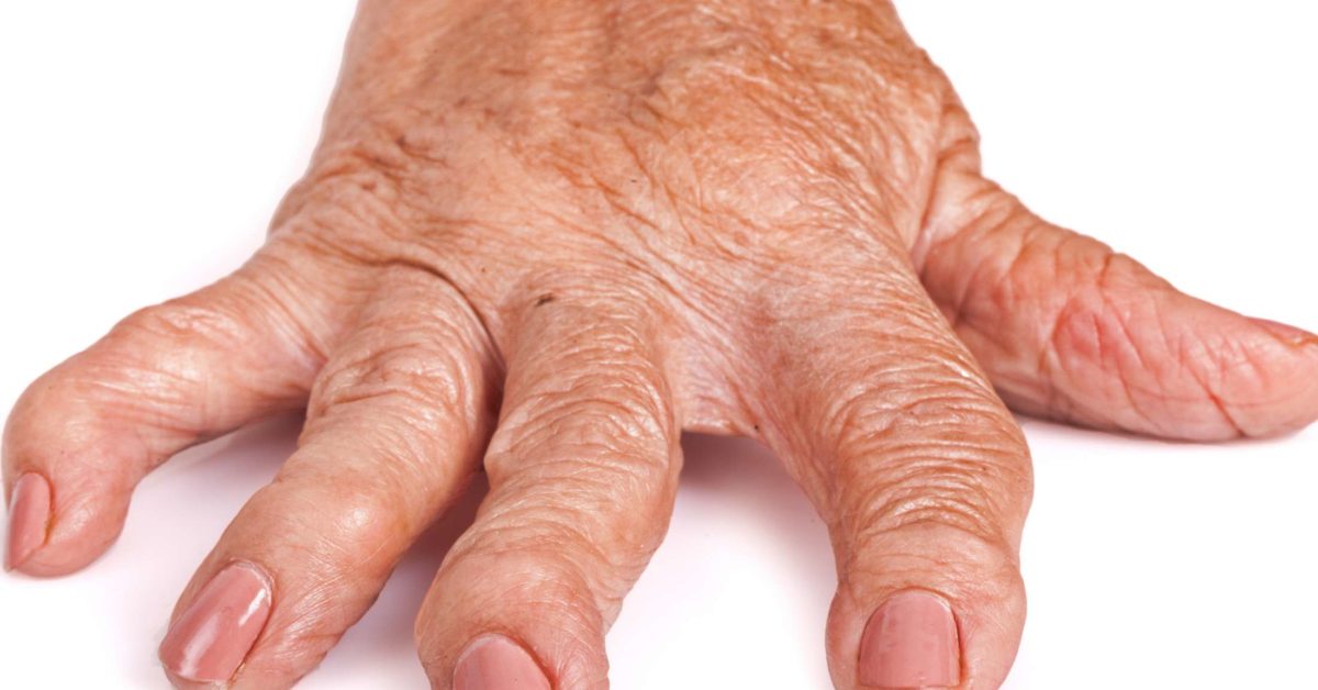 Rheumatoid arthritis pictures: Symptoms in the joints