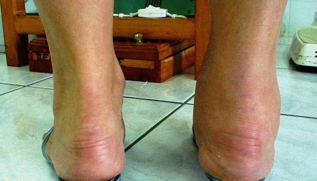 arthritis symptoms in legs