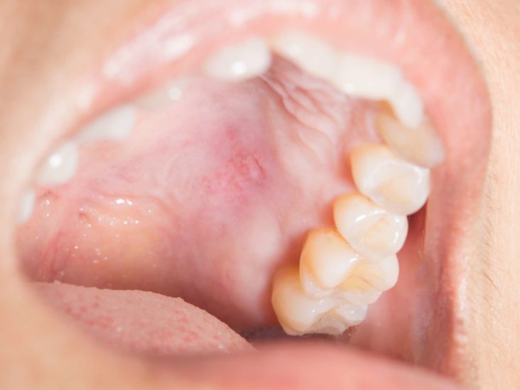 mouth ulcer