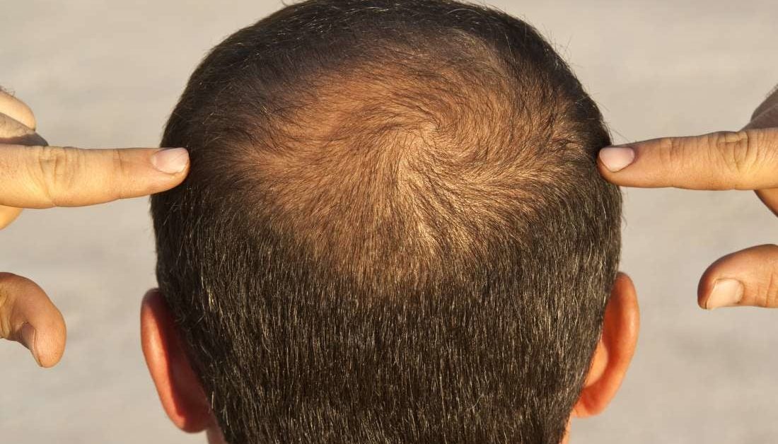 Hair loss: Scientists test wearable regrowth device