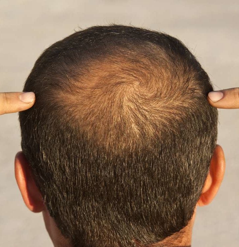 hair-loss-scientists-test-wearable-regrowth-device