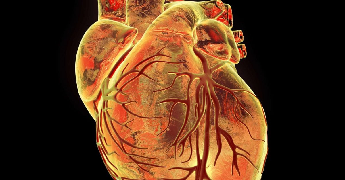 What is an aortic dissection? My experience