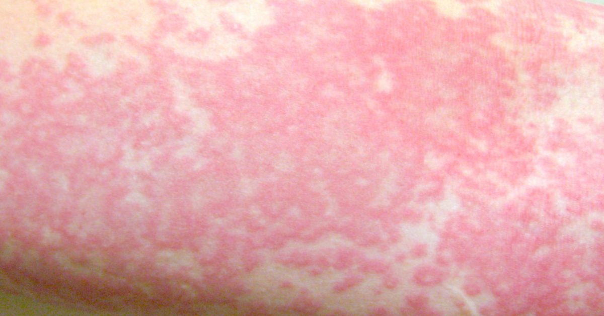 Chlorine Rash & Swimmer's Itch: Pictures, Symptoms, & Treatment