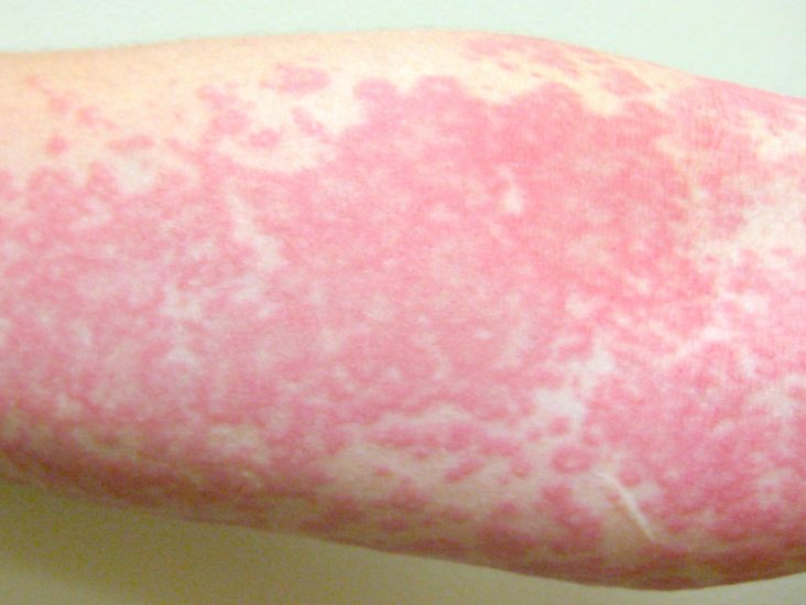 Rash on Inner Thigh: Causes and Effective Home Treatments
