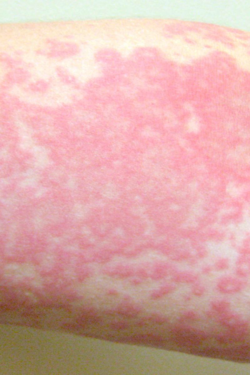 Chlorine Rash: Symptoms, Treatment, Prevention