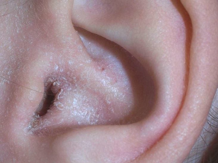 psoriasis flakes in ear