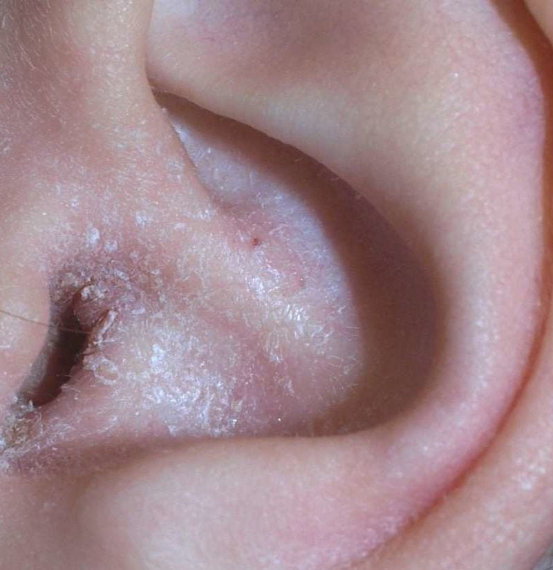 psoriasis in the ear canal symptoms