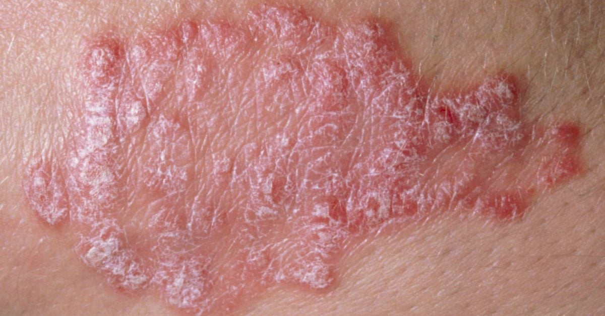 is psoriasis an inflammatory disease vörös foltok jelennek meg a kezeken a napon