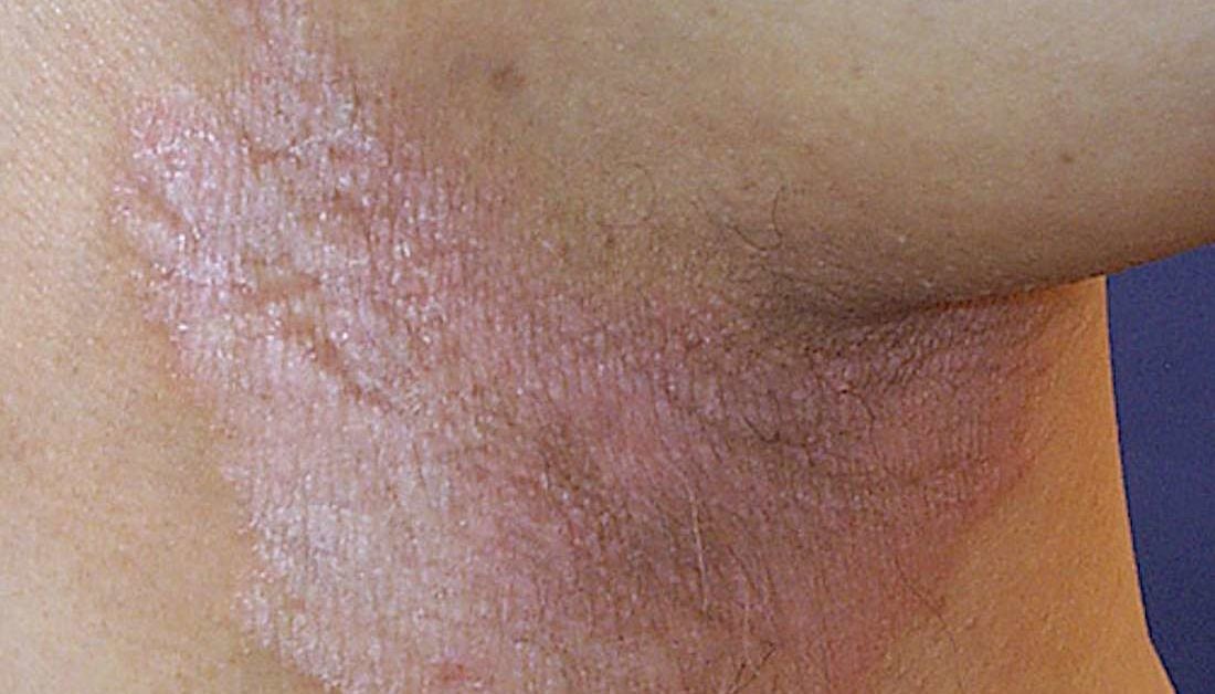 Skin Concern] Hyperpigmentation and redness on bikini line :  r/SkincareAddiction