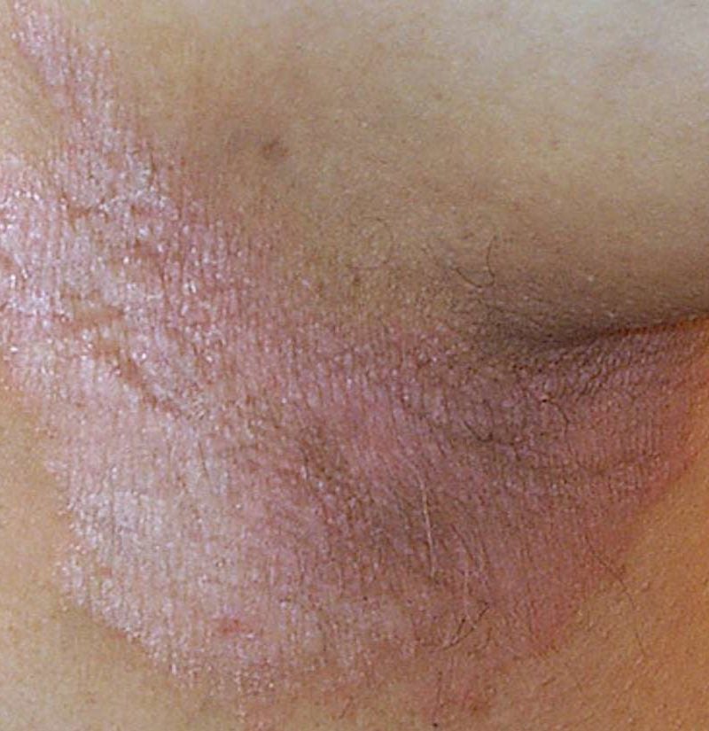 inverse psoriasis or jock itch)