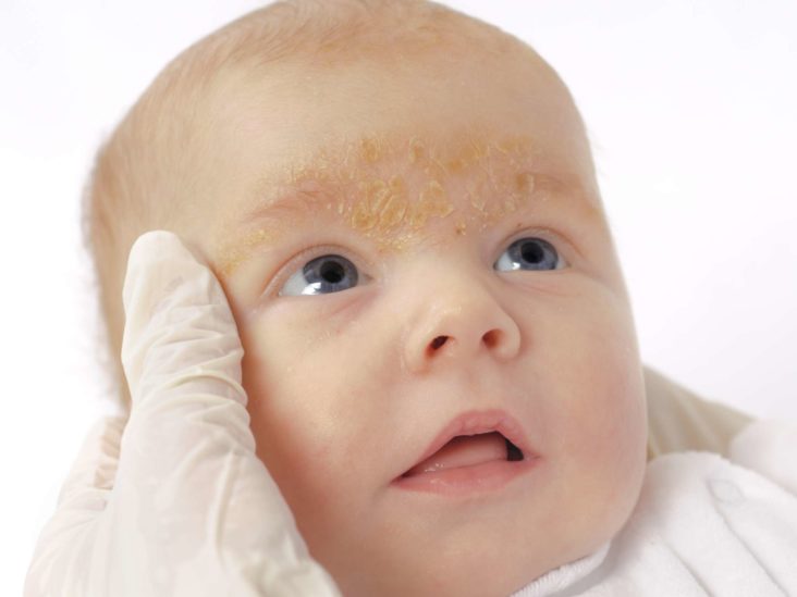 psoriasis in babies nhs