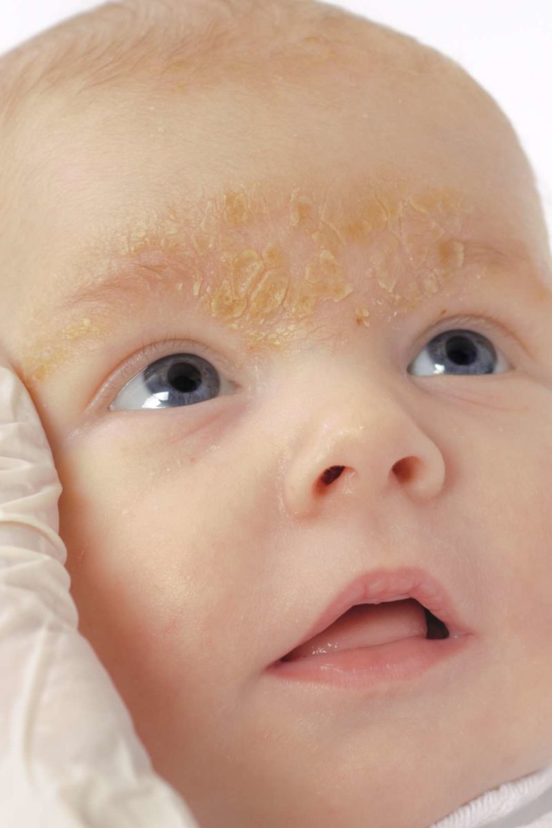 Rash On A Baby S Face Pictures Causes And Treatments