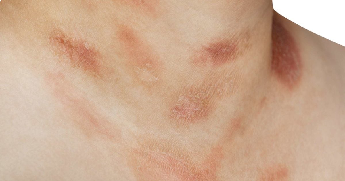 guttate psoriasis herald patch tenyér viszket és vörös foltok